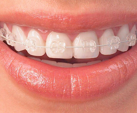 Ceramic Braces