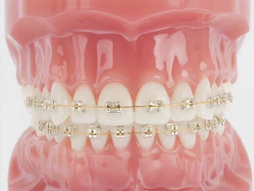 Champagne Braces