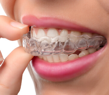 Invisalign Braces