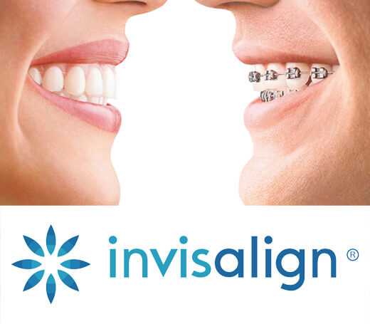 Invisalign