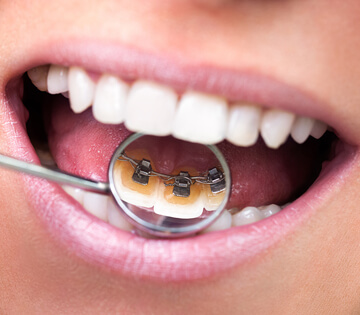 Lingual Braces