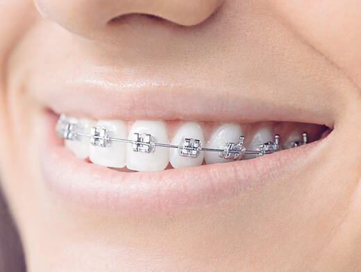 Metal Fixed Braces
