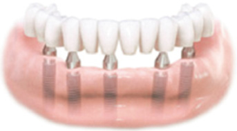 An Implant Supported Bridge Replacing All of the Teeth