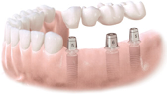 An Implant Supported Bridge Replacing Several Missing Teeth