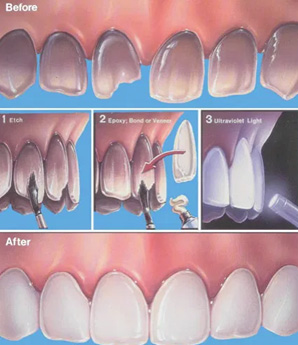 How are Porcelain Veneers Applied