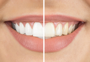 Teeth Whitening