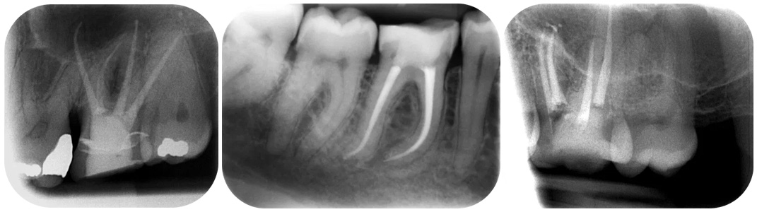 What is the success rate of root canal treatment?