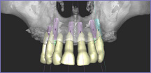 What to expect with Dental Implant Treatment