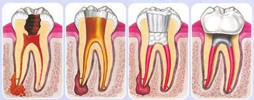 Why is root canal treatment needed?